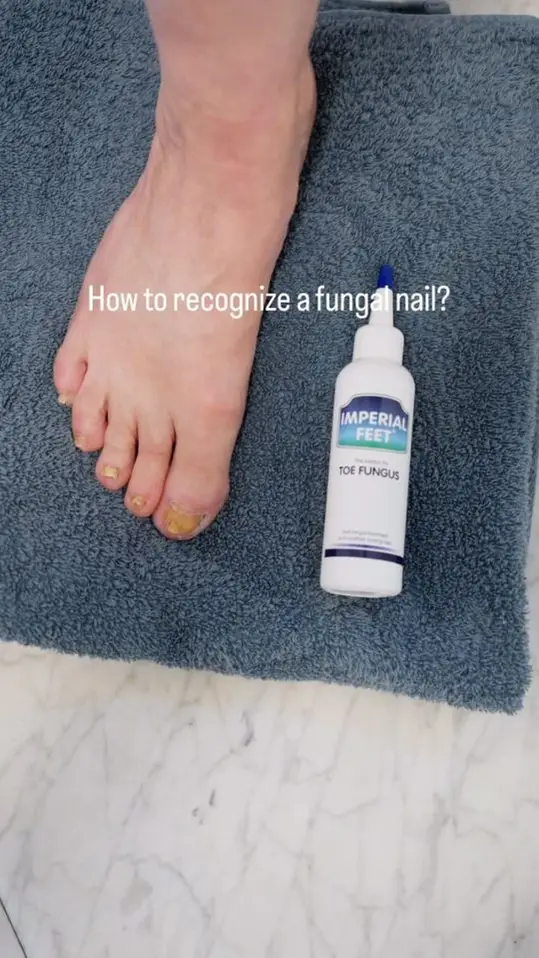 Reelcover van Imperial Feet: een voet met een flesje ernaast, met de tekst How to recognize a fungal nail.